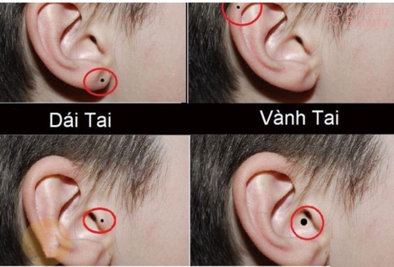 Nốt ruồi tai có ý nghĩa như thế nào?