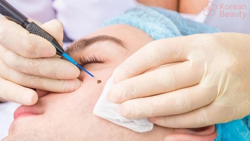 Thông tin tổng quan về cách tẩy nốt ruồi công nghệ cao