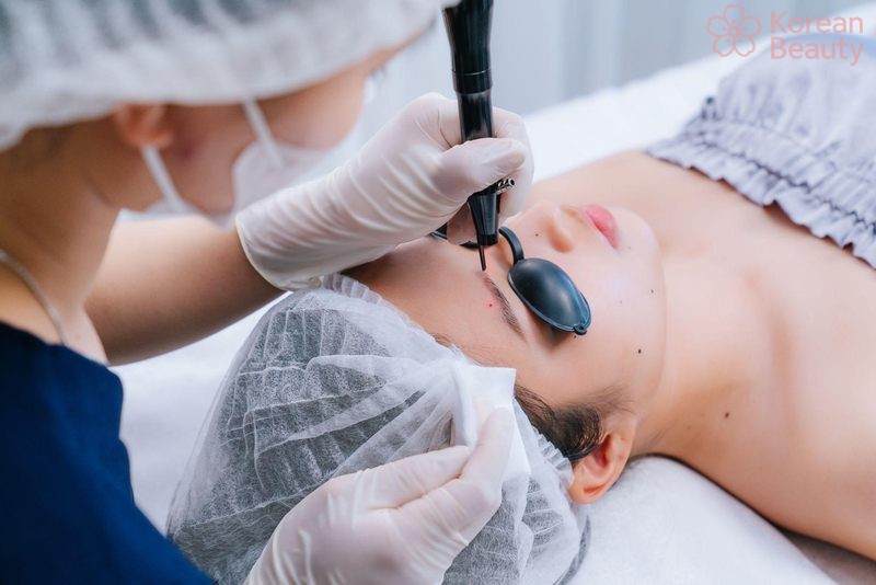 Những yếu tố quan trọng cần lưu ý trước khi thực hiện tẩy nốt ruồi công nghệ cao