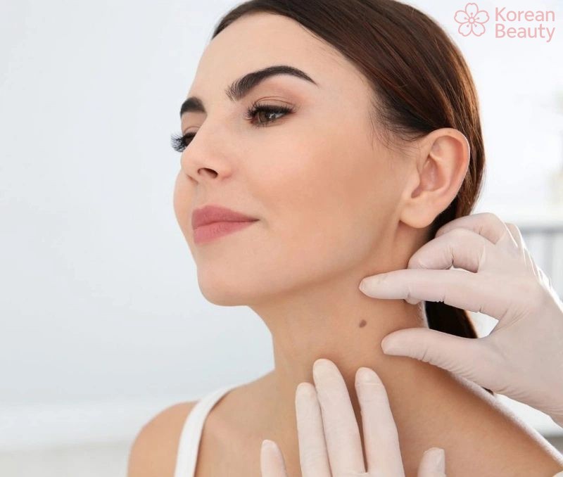 Nên thực hiện tẩy nốt ruồi ở dâu hiệu quả nhất và an toàn