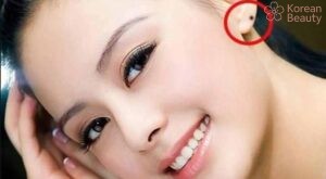 Ý nghĩa về mặt tướng số của nốt ruồi tai