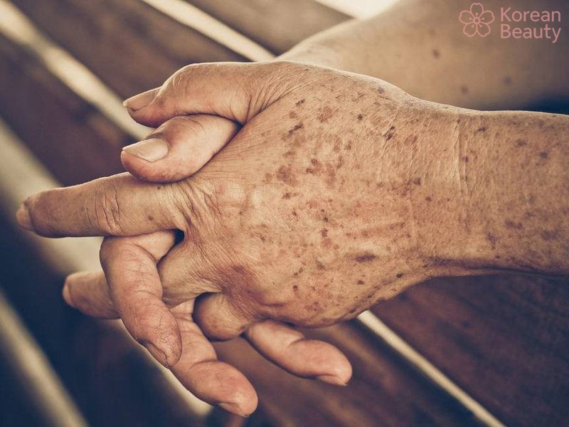 Những phương pháp điều trị da nổi đốm nâu không ngứa hiệu quả