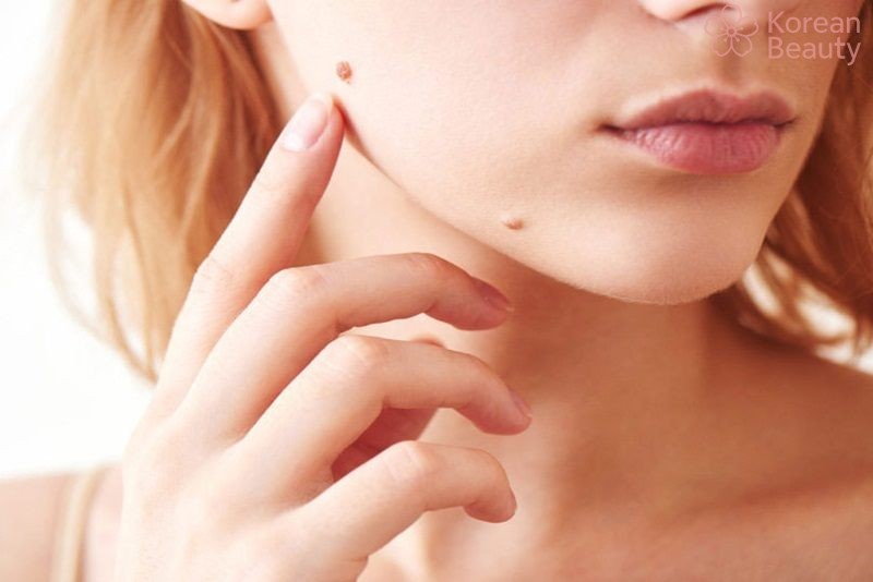 Những lưu ý quan trọng khi thực hiện tẩy nốt ruồi hà nội