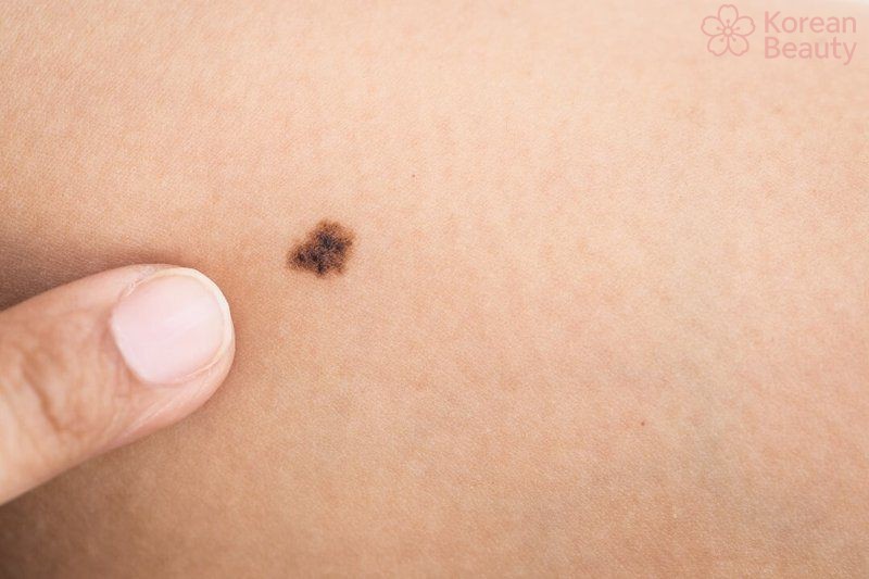 Những trường hợp nào không nên thực hiện tẩy nốt ruồi