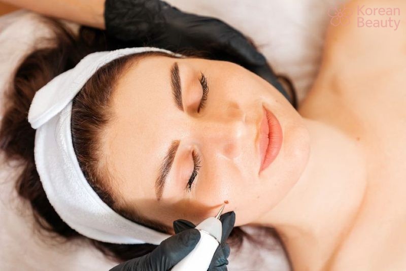 Những bí quyết hay từ những người đã thực hiện tẩy nốt ruồi tại Hải Phòng