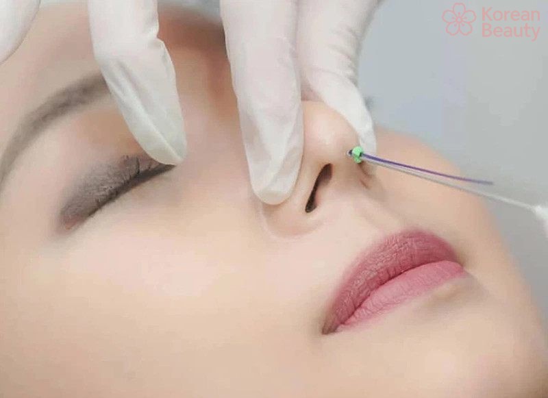 Những đối tượng phù hợp và không phù hợp để có thể nâng mũi bằng chỉ