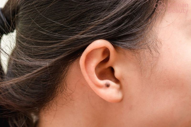 Cách chăm sóc và theo dõi nốt ruồi tai như thế nào?