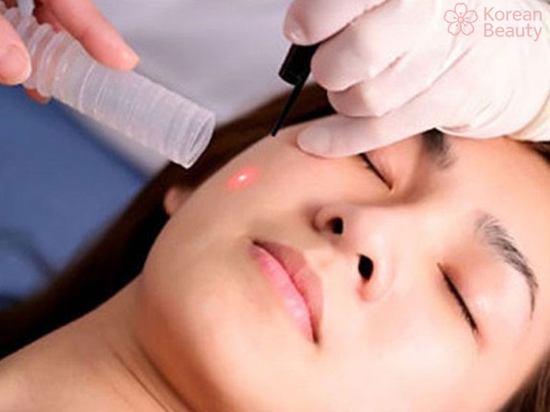 Xu hướng thực hiện tẩy nốt ruồi công nghệ cao phổ biến nay