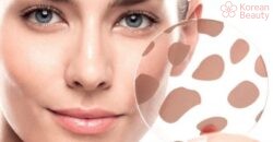 Kết hợp nhiều phương pháp để điều trị da xuất hiện vết thâm nâu hiệu quả