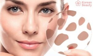 Kết hợp nhiều phương pháp để điều trị da xuất hiện vết thâm nâu hiệu quả