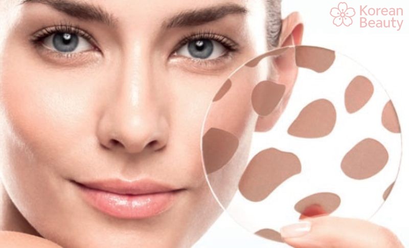 Kết hợp nhiều phương pháp để điều trị da xuất hiện vết thâm nâu hiệu quả
