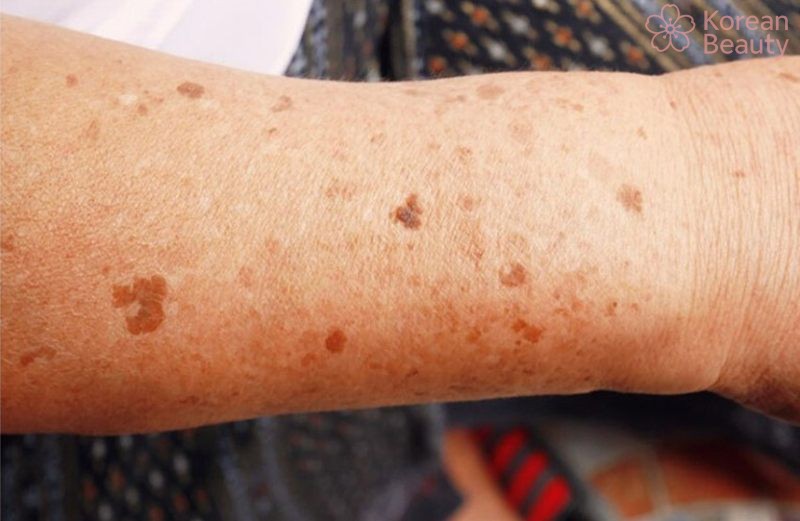 Những tình trạng đặc biệt liên quan đến bệnh da nổi đốm nâu không ngứa