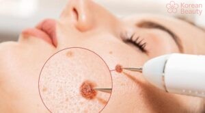 Những thắc mắc thường gặp khi thực hiện tẩy nốt ruồi