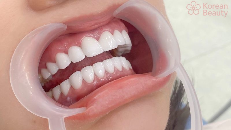 Chế độ chăm sóc sau khi áp dụng cách vệ sinh răng miệng sau khi phun môi