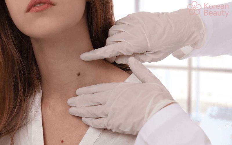 Những vấn đề phổ biến về cách tẩy nốt ruồi Hà Nội